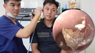 💫耳かき | 耳掃除 | 患者が偶然医師に出会った 💖 DR. LAI MINH TUAN