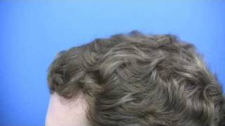 Hair Transplant by Dr Hasson - 3113 Grafts - 1 Session