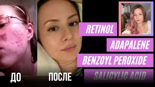  УХОД ЗА ПРОБЛЕМНОЙ ЖИРНОЙ КОЖЕЙ ЛУЧШЕЕ ОТ ПРЫЩЕЙ ПОДКОЖНИКОВ и СЫПИ 
