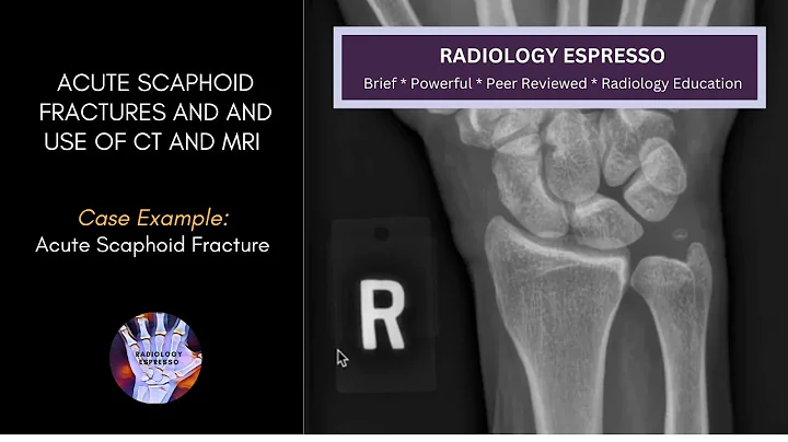 ACUTE SCAPHOID FRACTURES AND FRACTURE COMPLICATIONS: Case Example – Acute Scaphoid Fracture