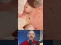 Derm reacts to cystic blackhead removal blackheadremoval cystremoval dermreacts