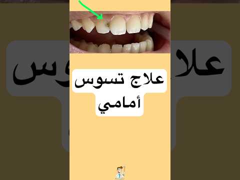 علاج تسوس امامي اسناني العناية بالأسنان  تجميلاسنان صحة الأسنان