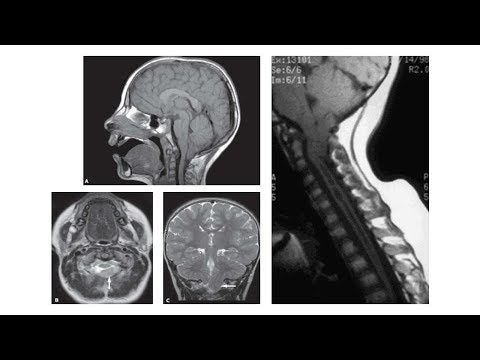 Video Bất thường bẩm sinh não, Bs Cao Thiên Tượng - YouTube