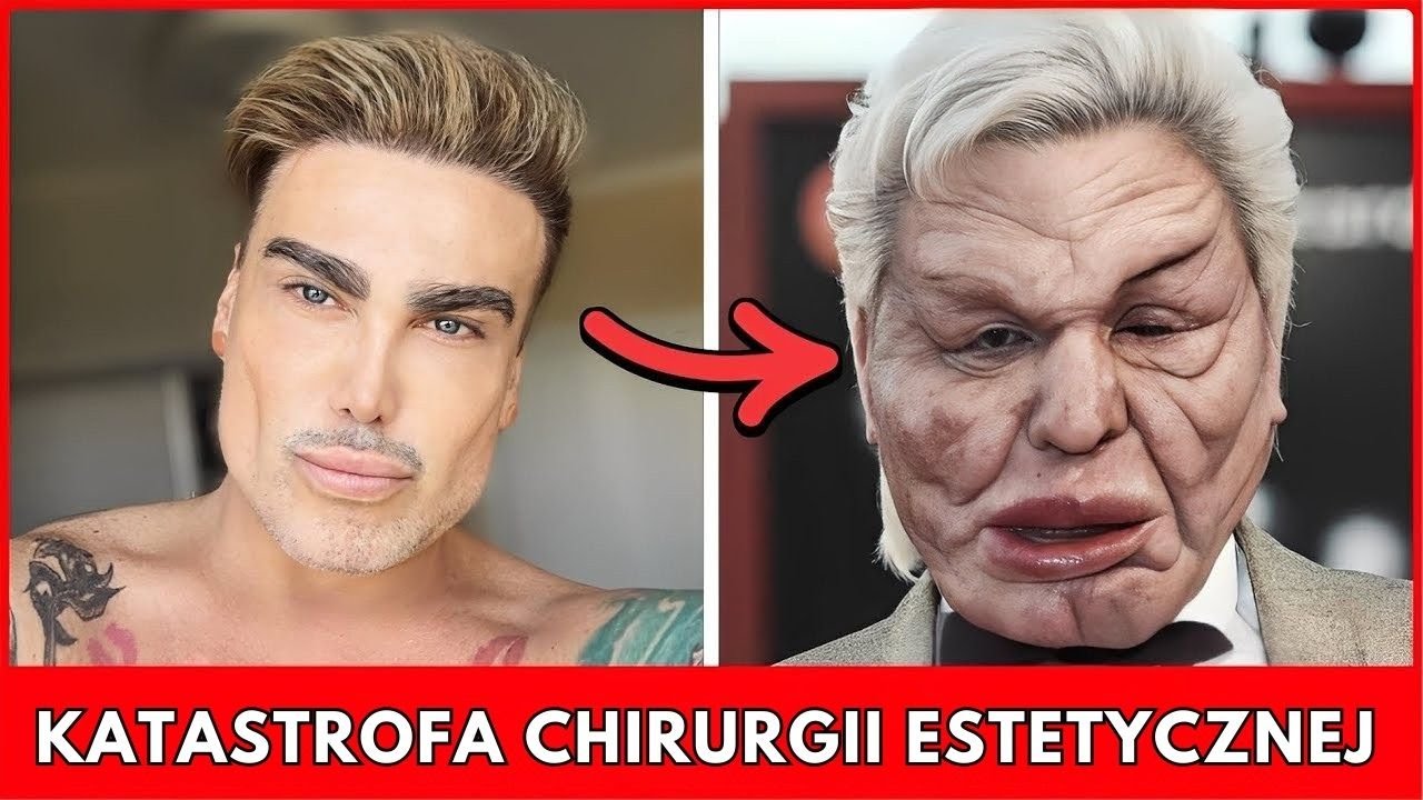 Największe Katastrofy Chirurgii Plastycznej Wśród Celebrytów