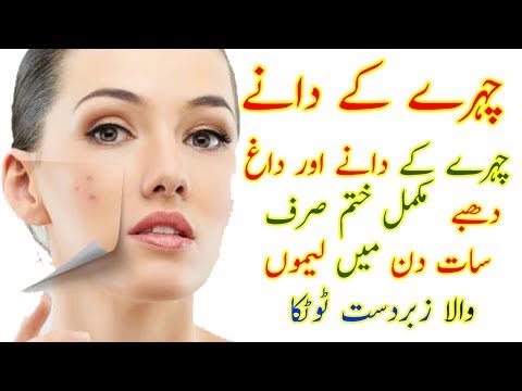 Chehre ke dano ka ilaj in urdu / Acne and Pimples Treatment in Urdu