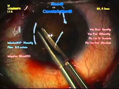 眼内レンズ交換（白内障術後3ヶ月）　山王台病院付属眼科内科クリニック