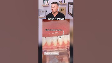 Dentist Reveals How They Fix The DREADED Black Triangles! 😭🦷