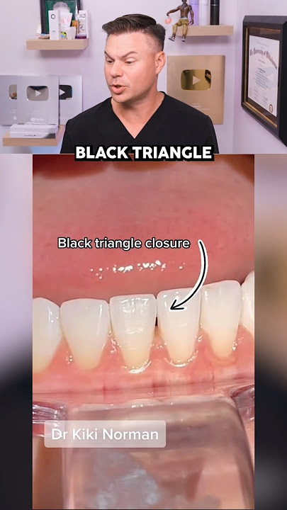 Dentist Reveals How They Fix The DREADED Black Triangles! 😭🦷