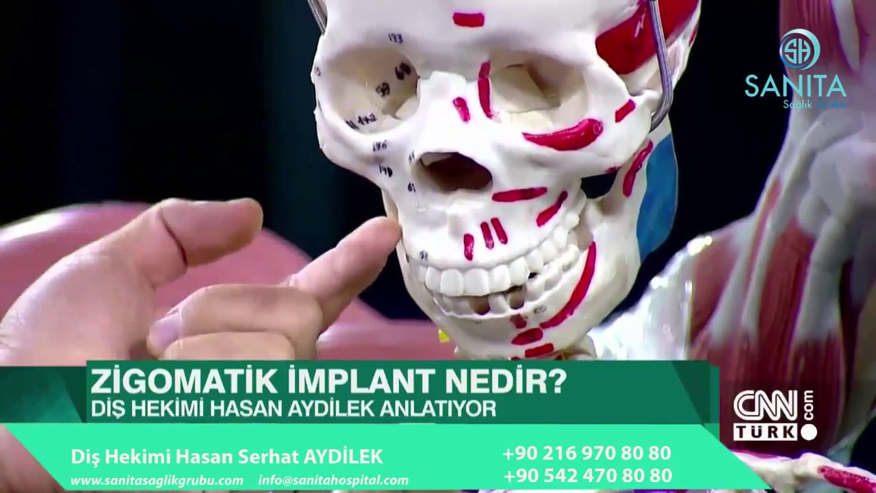 İmplant Tedavisinde yeni dönem / ZİGOMATİK İMPLANTLAR