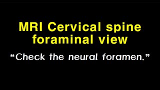 MRI Cervical spine foraminal view_english