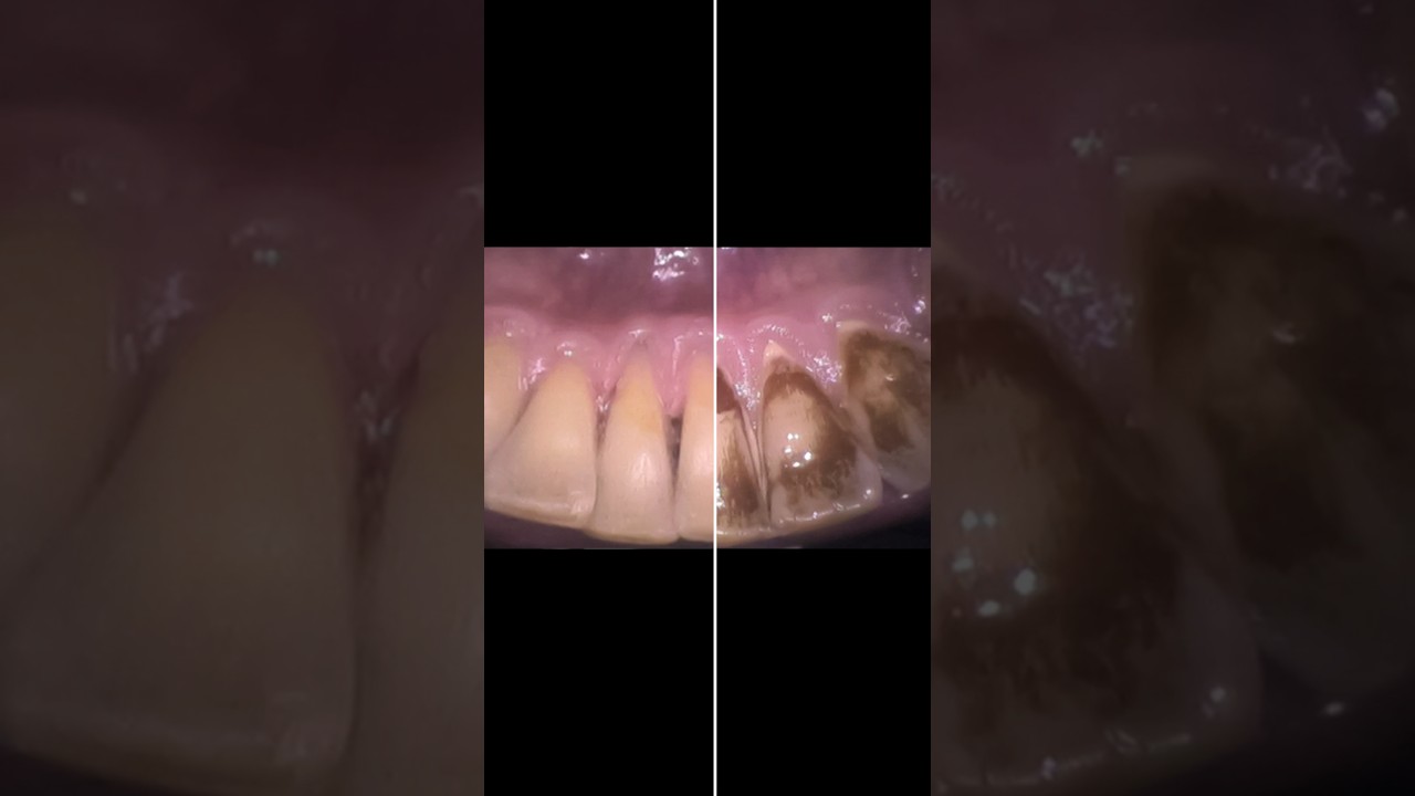 Smile Transformation at Mint Dental Hygiene Takapuna! Watch Nova Edgcombe's expert care in action!