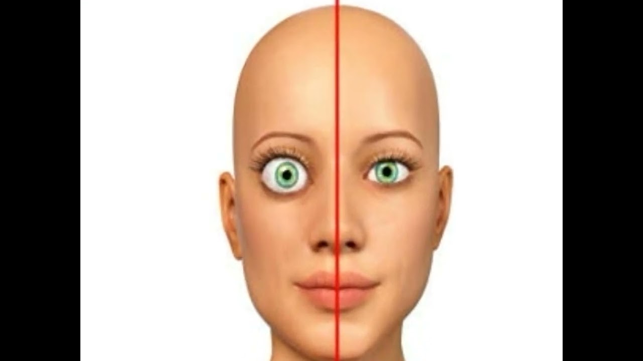 Pathophysiology of Graves Disease YouTube