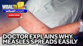 Measles very contagious. Doctor explains how - YouTube
