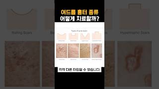 여드름 흉터치료 방법, 타입별로 달라지는 이유 Part1.