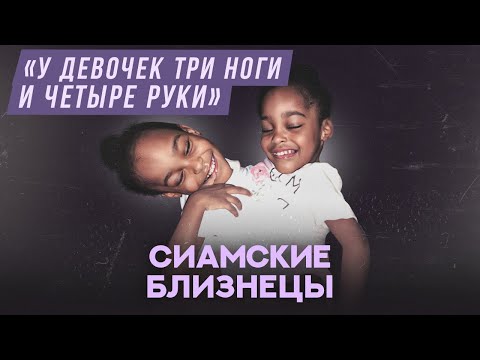 Видео: Сиамские близнецы | Хочу спросить