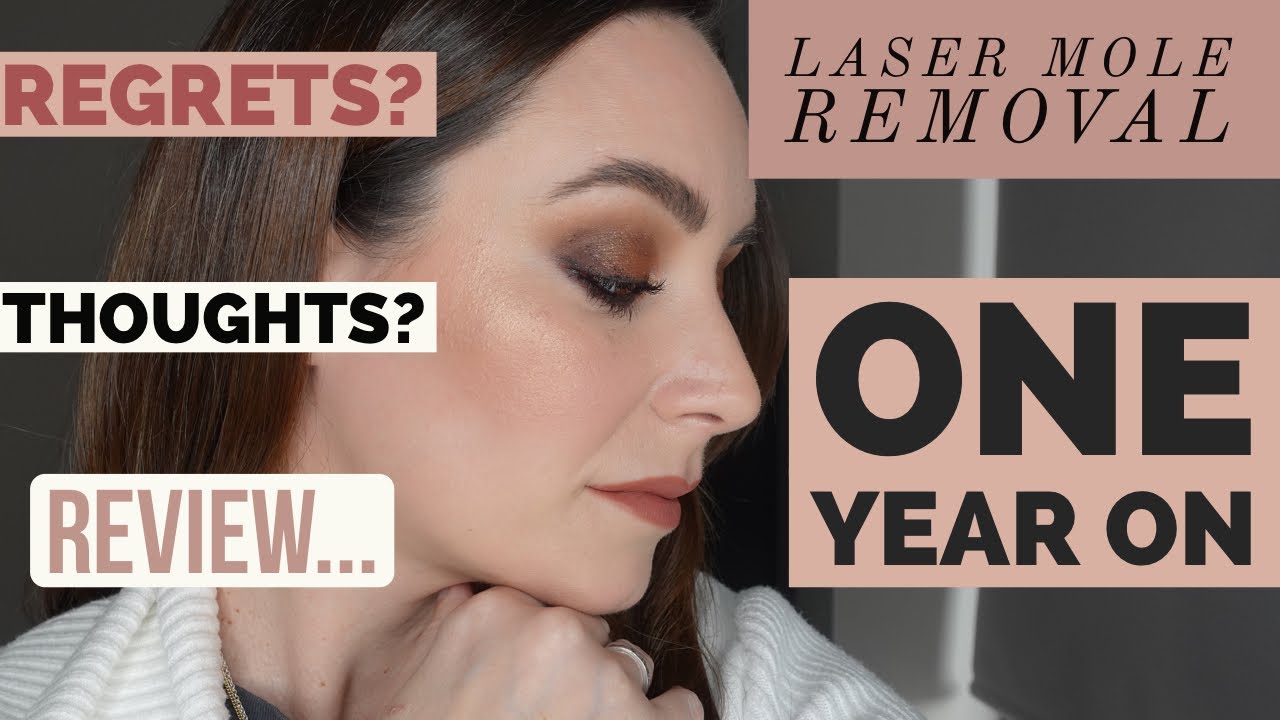 Laser Mole Removal | One Year On | Facial Mole Removal | Is There Scarring | Any Regrets |