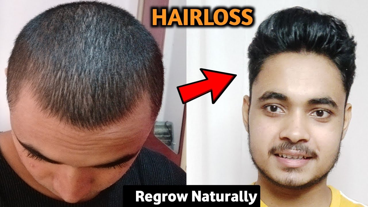 How to Stop Hairfall Naturally | Regrow hair | Hair Regrowth for men ...