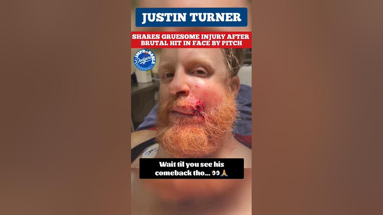 ⚠️😵 Justin Turner GRUESOME injury hit in face by pitch knocked to ground,  COMEBACK recovery‼️🙏 💪 