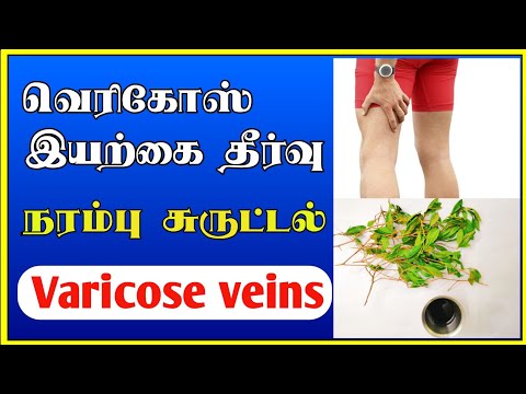 நரம்பு சுருட்டல் | Home remedies for Varicose veins in tamil  | Tamil | Thanithuvamm