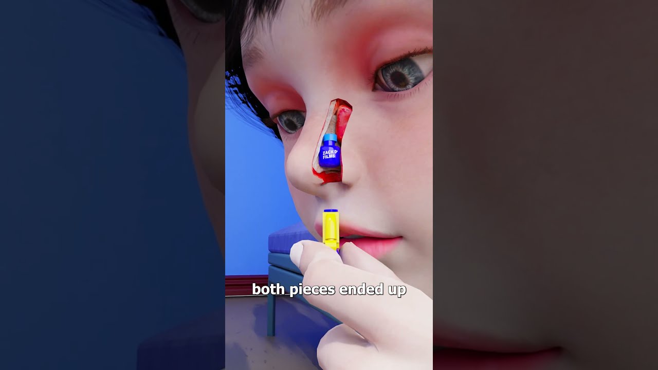 Lego Stuck In Nose For 26 Years 