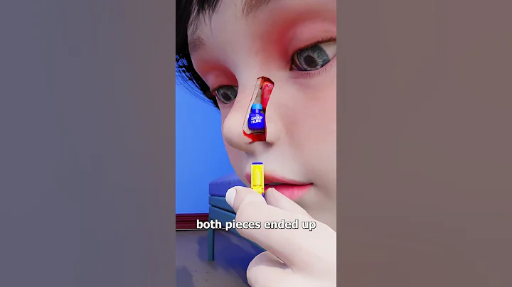 Lego Stuck In Nose For 26 Years 😨