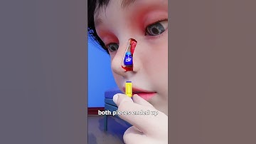 Thumbnail of Lego Stuck In Nose For 26 Years 😨