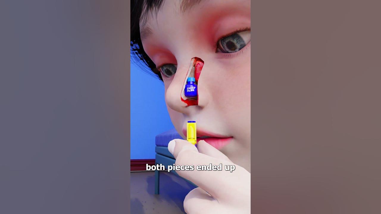 Lego Stuck In Nose For 26 Years π¨ Lego Stuck In Nose For 26 Years π¨