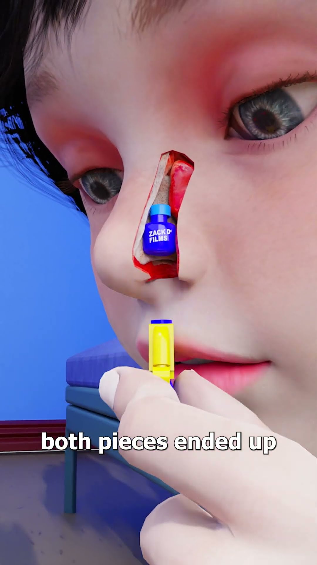 Lego Stuck In Nose For 26 Years ?