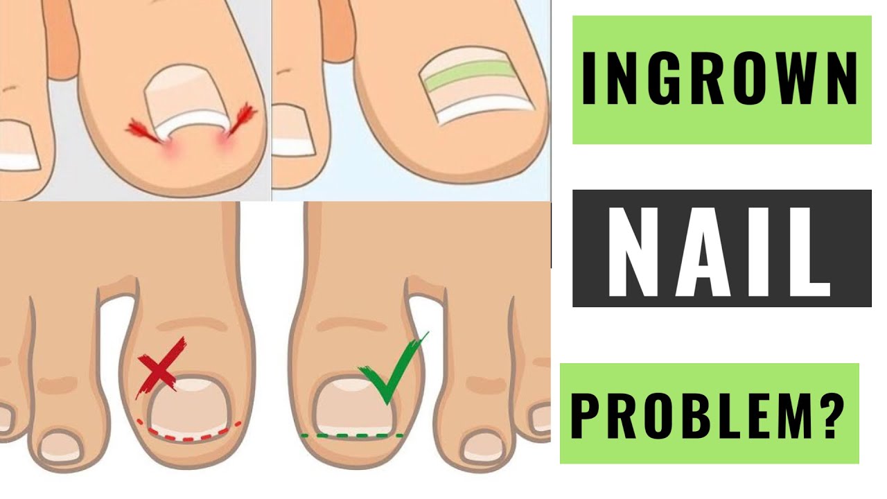 INGROWN NAILSIMPLE TECHNIQUE TO GET RID OF IT YouTube