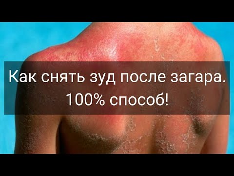 Как снять зуд после загара и что делать если получил солнечный ожог.