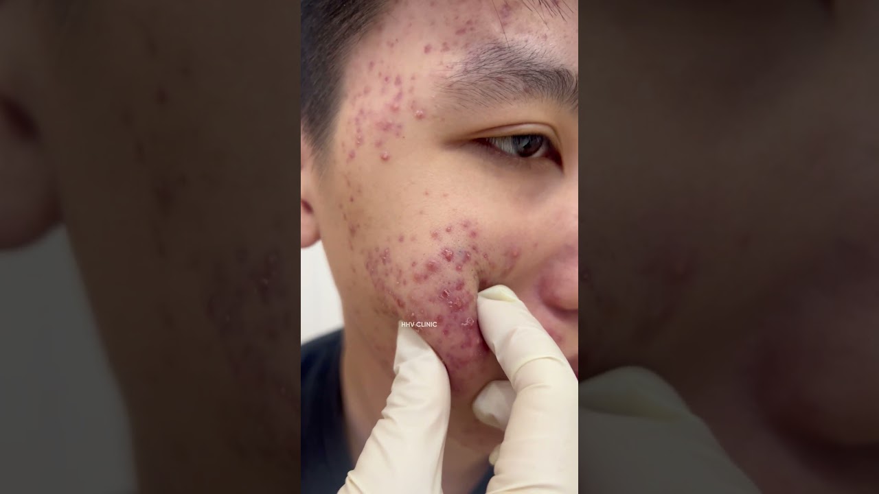 Mụn viêm chi chít kín má nhìn mà xót xa.