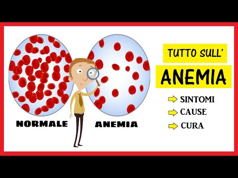 Video: Differenza Tra Anemia Microcitica E Macrocitica