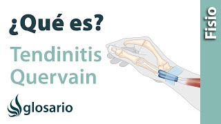 TENDINITIS DE DE QUERVAIN | ¿Qué es?