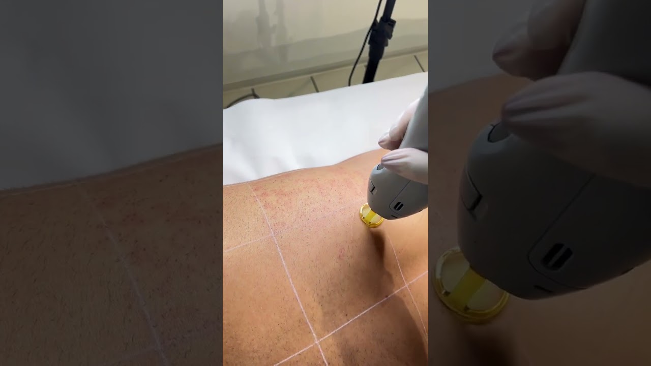 Dauerhafte Haarentfernung 