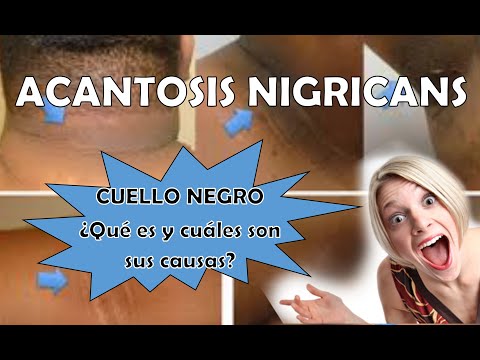 ACANTOSIS nigricans o CUELLO NEGRO, 5 Causas y tratamiento