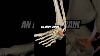 How To Fix An Ankle Sprain!