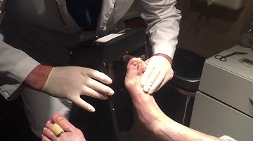 Digital Custom Foot Orthotic Casting - Dr. John D. Hollander.