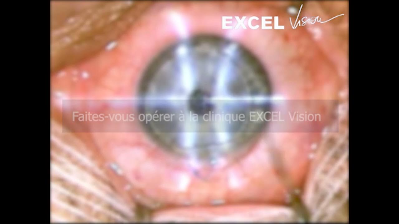 Vous ne supportez plus votre vision floue ? YouTube