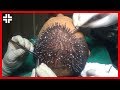 Hair Transplant Surgery 2018