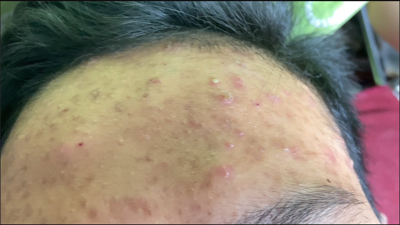 Acne Treatment Huong Da Nang#544  | 2023