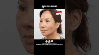 안면거상술+코수술+눈성형 후기 #shorts