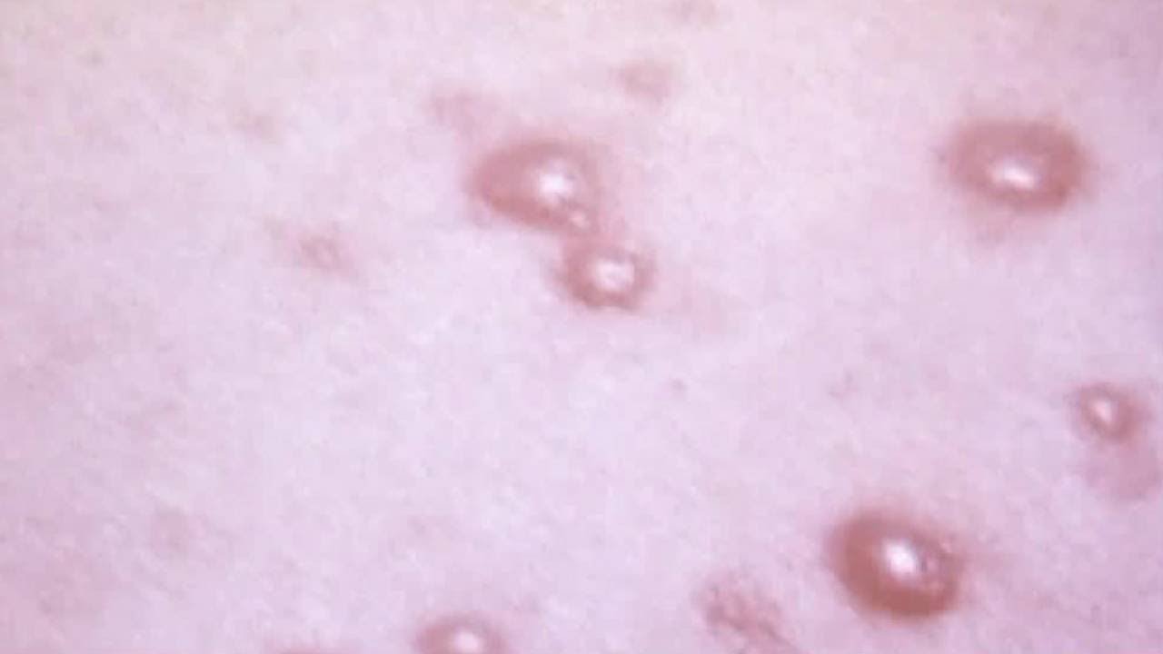 Good Health Understanding shingles YouTube