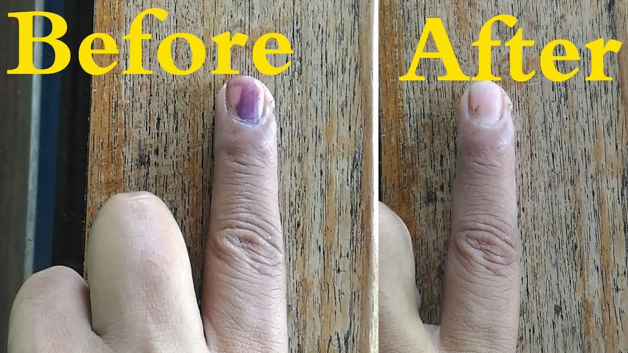 Removing Indelible Ink Voting Ink Tips For Indelible Ink YouTube removing-indelible-ink-voting-ink-tips-for-indelible-ink-youtube