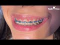 Braces permanent retainer - how do they put it - Tooth Time Family Dentistry New Braunfels