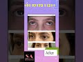 Lower eyes fat grafting  fat grafting of lower eyelid  dr shobhit gupta