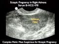 Ectopic Pregnancy Case Study - Part 2