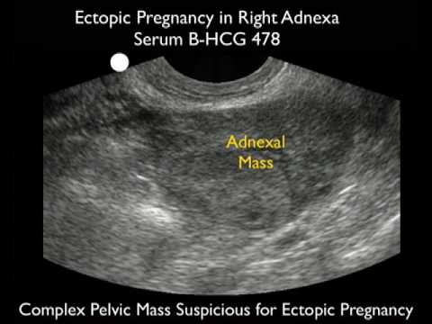 Oh MAN! - Interstitial Ectopic — Kwak Talk