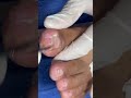 Ep_3684 Ingrown toenail removal 👣 ดูในยูทูป..บอกลูกต้องพามานะ 😷 (clip from Thailand)