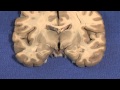 Hypothalamus: Neuroanatomy Video Lab - Brain Dissections