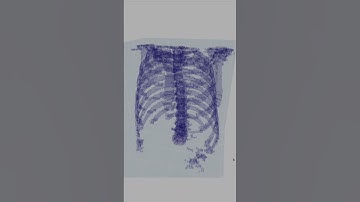 Lungs and Rib Cage 3D model through Segmentation of Chest CT Scan